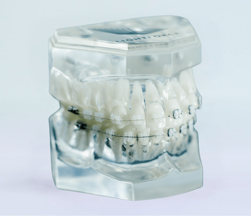 ceramic braces on plastic model