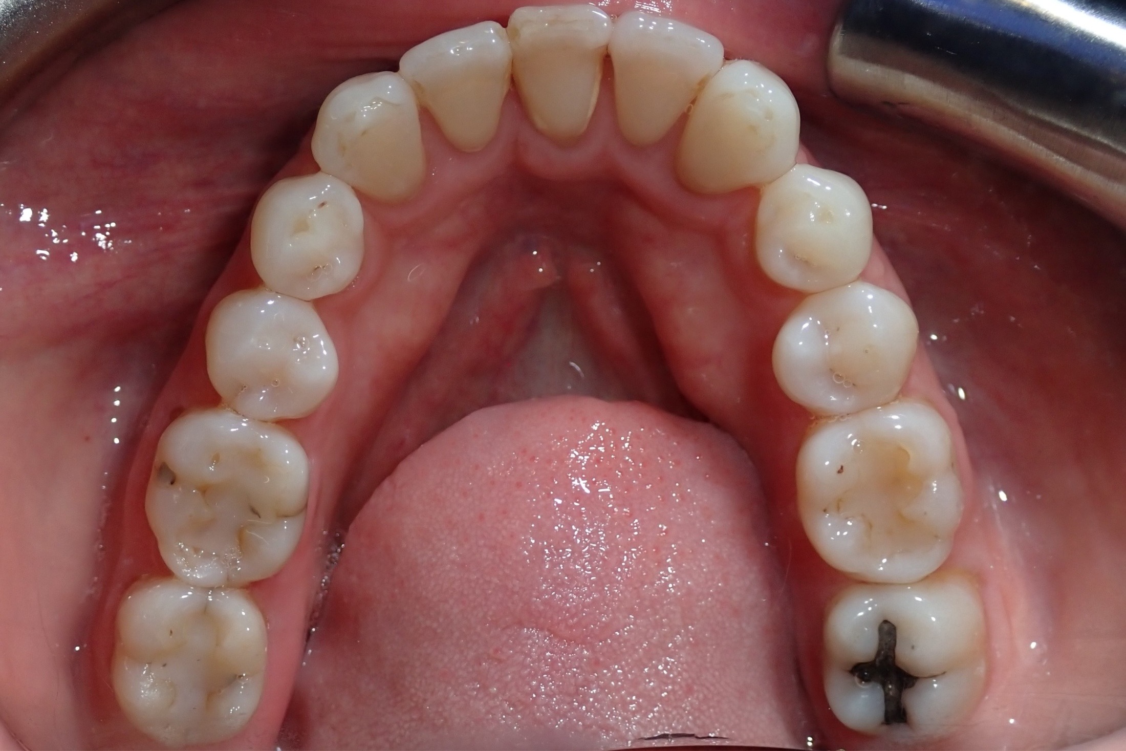 Patient-1-After