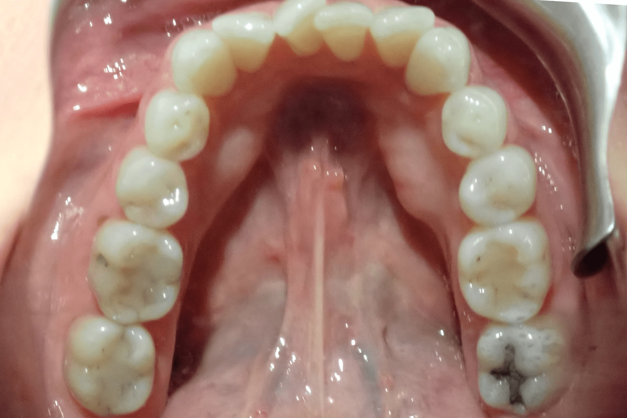 Patient-1-before-2 (1)