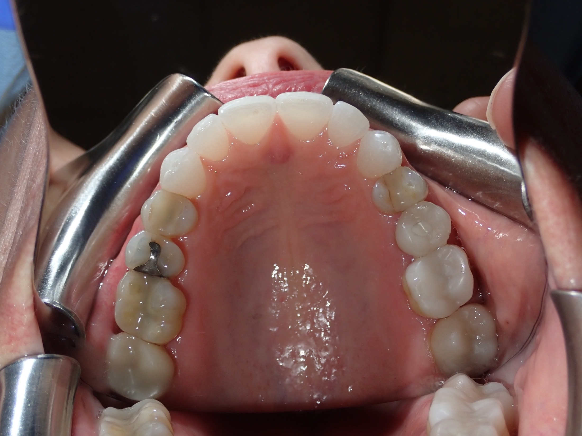 Patient 4 - After