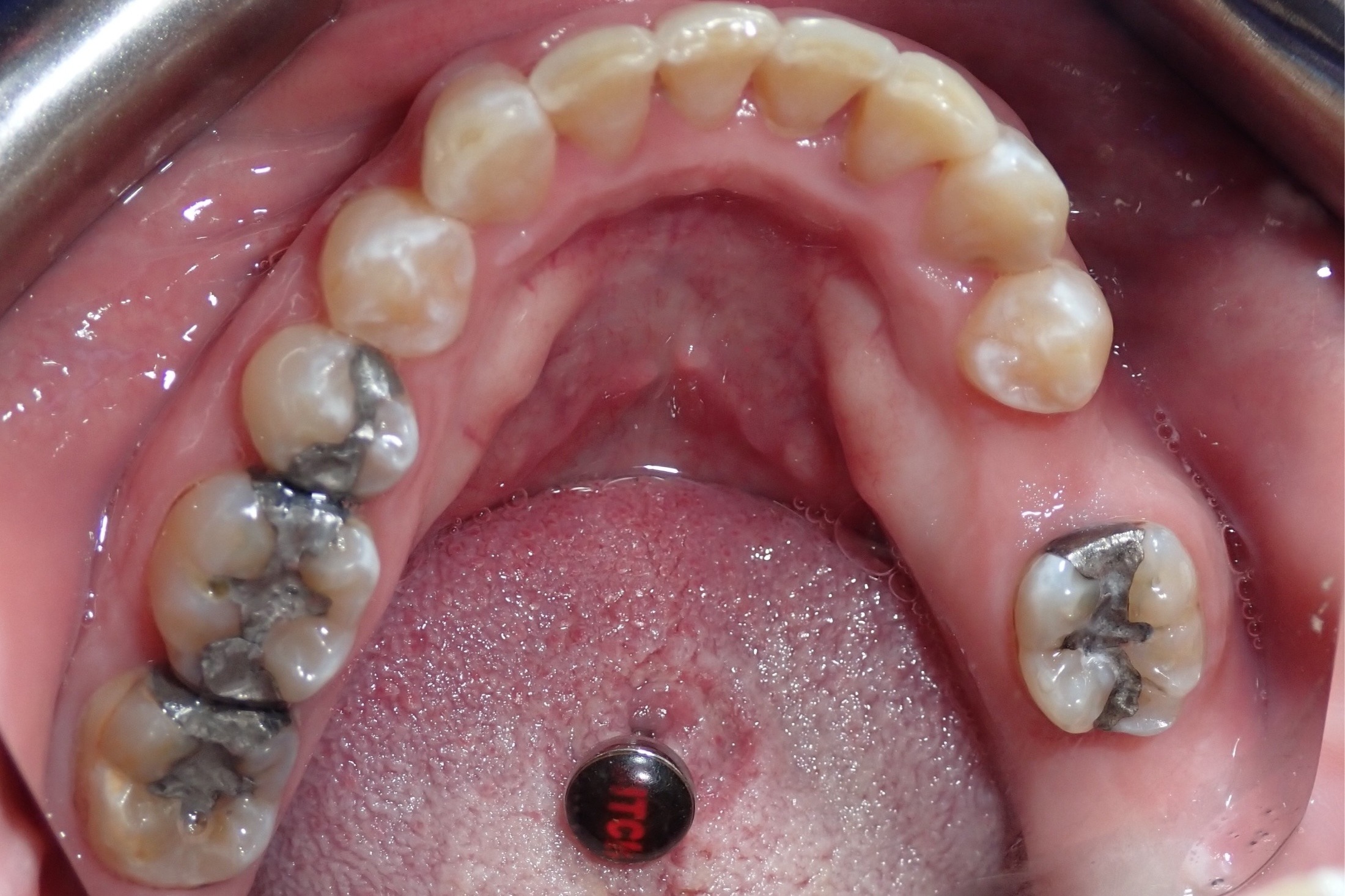 Patient-5-After