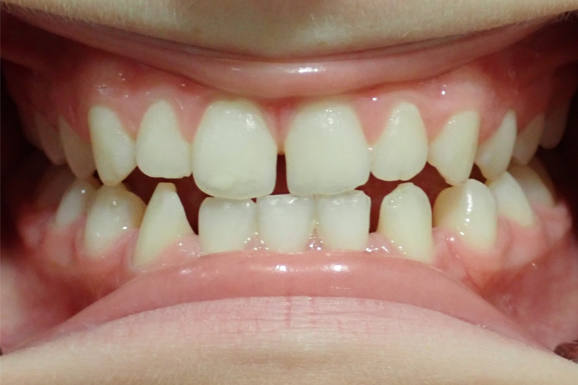 Patient 6 - Before