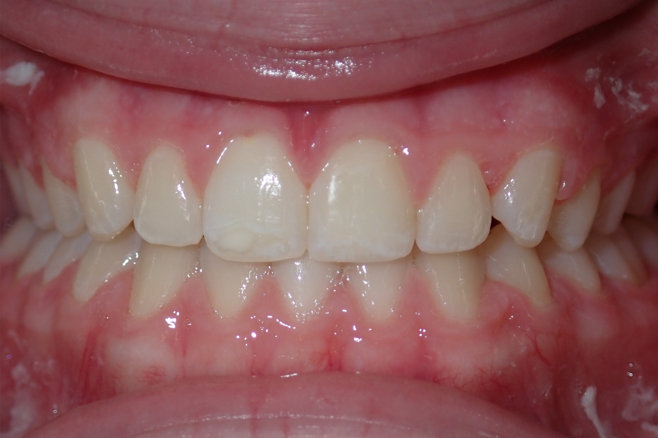 Patient 6 - after